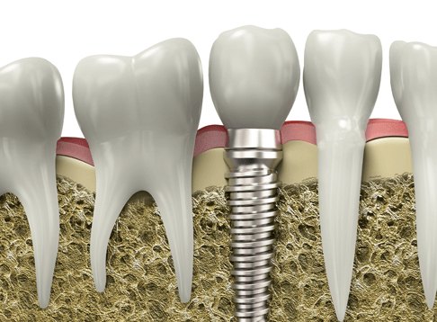 Своевременное восстановление утраченных зубов путем имплантации под ключ поможет не только избежать таких неприятностей, но и уменьшить расходы на лечение. 